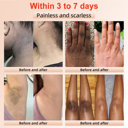 Purifying Exfoliating Gel for Acanthosis Nigricans, Exfoliation, Dark Spots, Skin Tags, Eczema