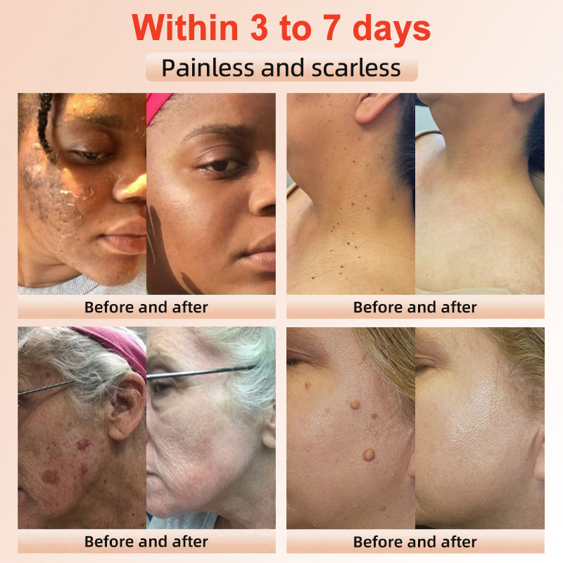 Purifying Exfoliating Gel for Acanthosis Nigricans, Exfoliation, Dark Spots, Skin Tags, Eczema